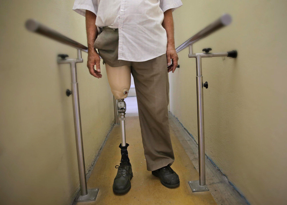 CCSS enviará personal a capacitarse para casos de prótesis