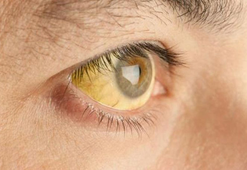 Ministerio de Salud confirma brote de hepatitis A en Puntarenas 