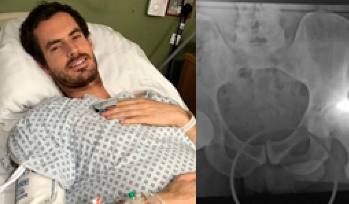 (+VIDEO) Andy Murray enciende las redes sociales con esta radiografía 