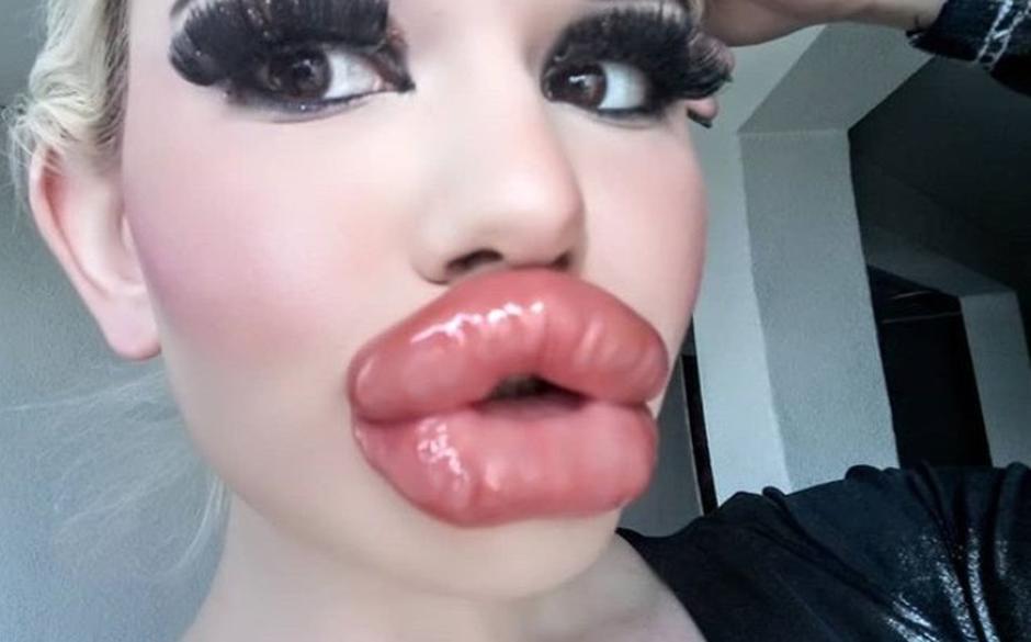 Influencer busca romper récord en aumento de labios a pesar de batallar para comer