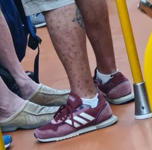 En la fotografía se le observa al hombre con lesiones en las piernas. En la fotografía se le observa al hombre con lesiones en las piernas.