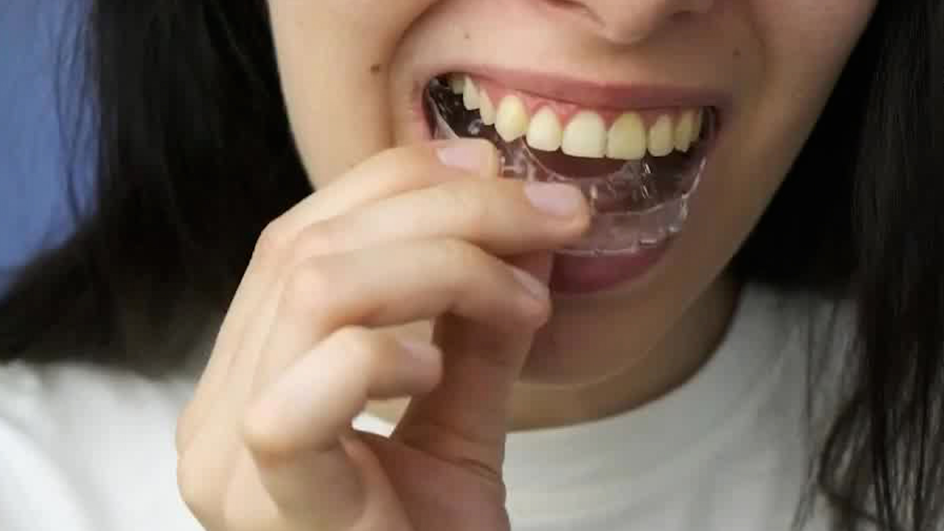 Alineadores dentales son vendidos en redes sociales