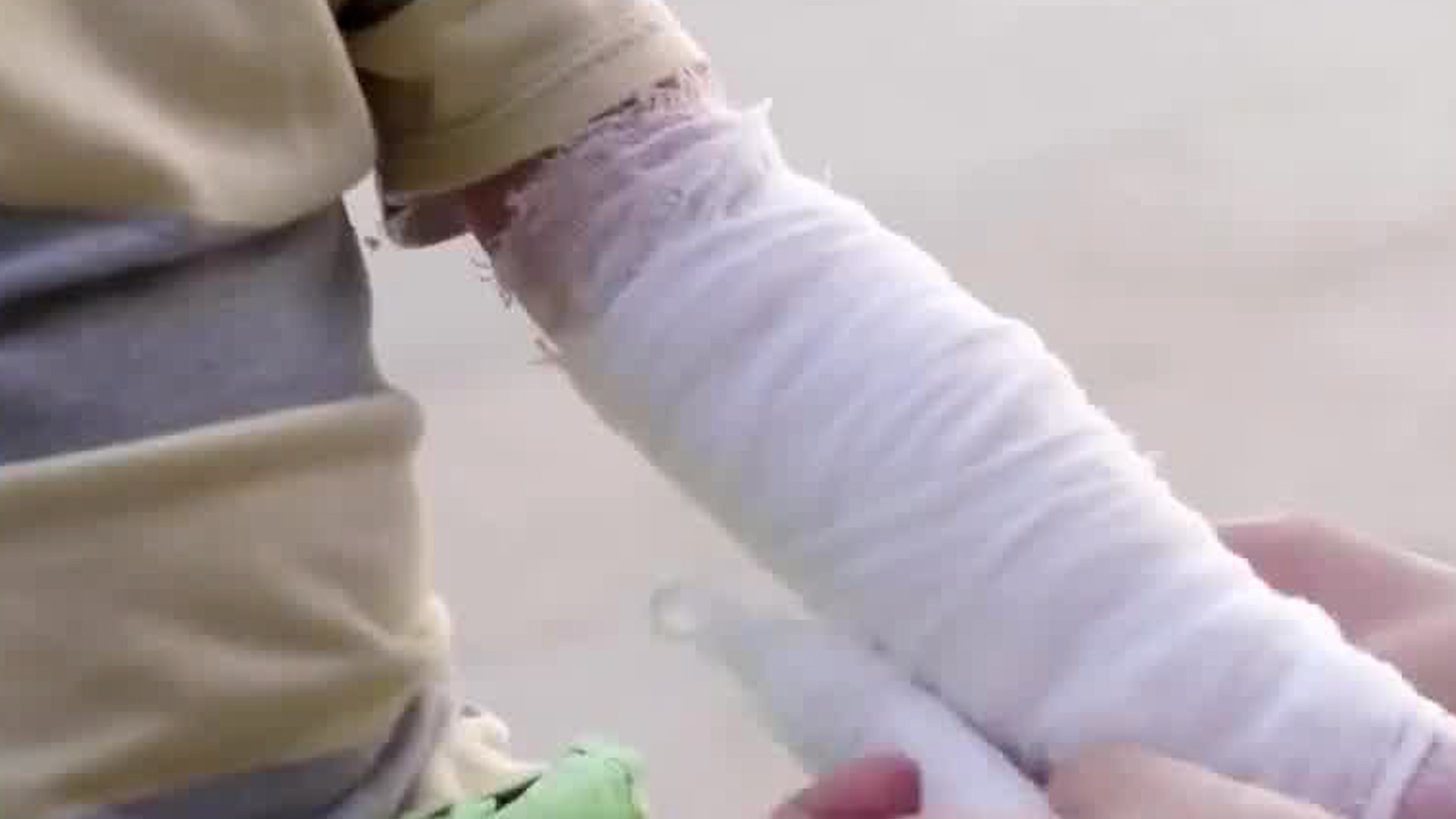 Más de 200 niños han sido atendidos por quemaduras este año