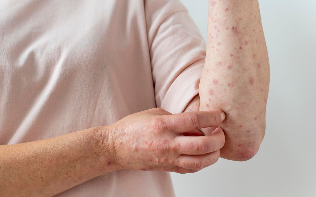 Ministerio de Salud confirmó dos casos de sarampión en el país. (Freepik)