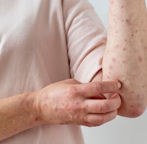 Ministerio de Salud confirmó dos casos de sarampión en el país. (Freepik)