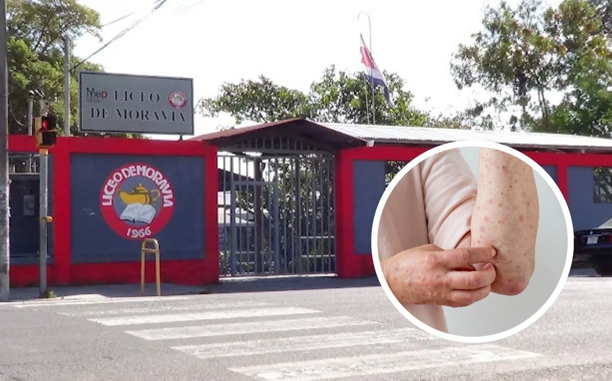 Suspenden lecciones por caso de sarampión.