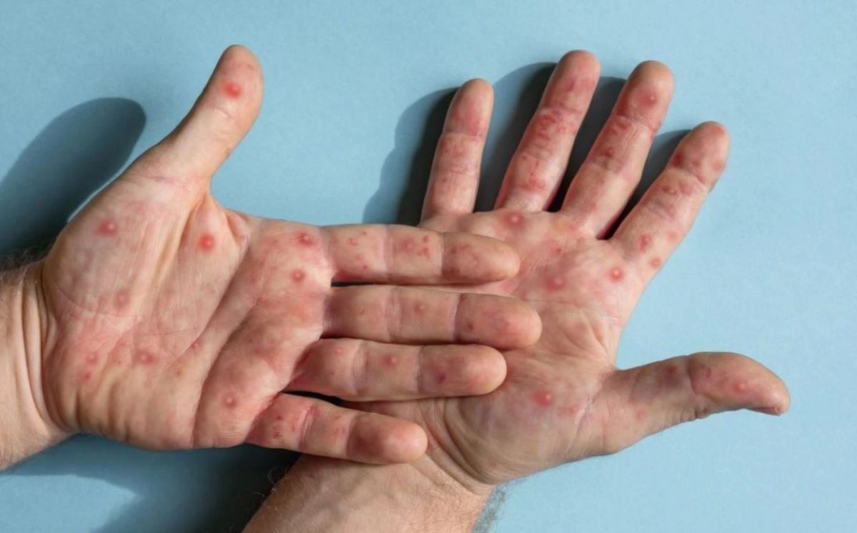 Inciensa confirmó dos casos de viruela símica en hombres. (Foto: Forbes)