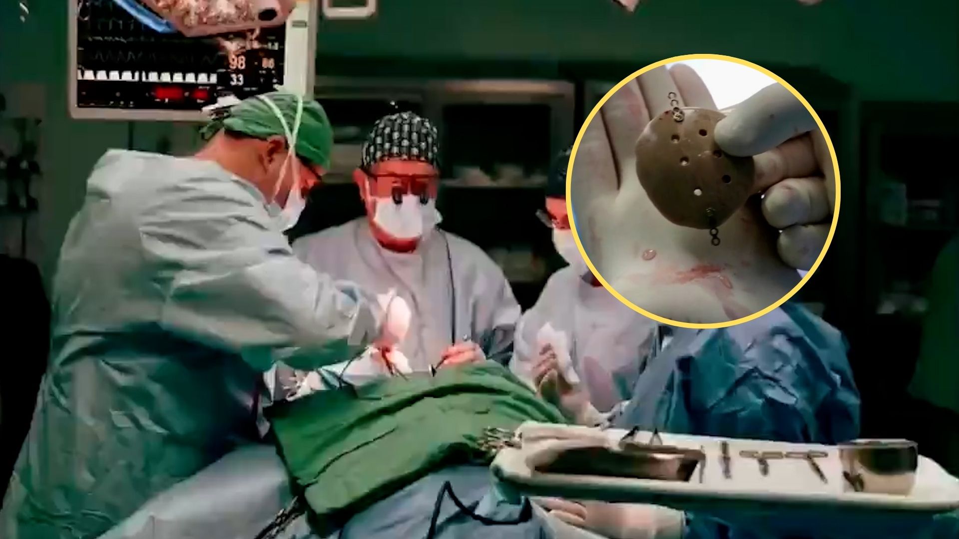 Implantan primera prótesis craneal impresa en 3D